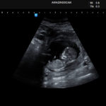 ultrasound